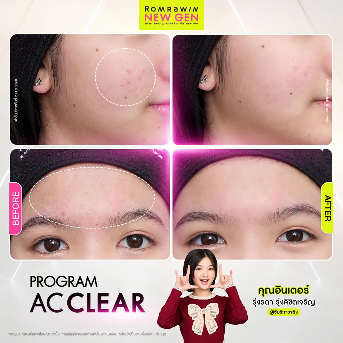 รีวิวเจาะลึก Before After โปรแกรม AC Clear รักษาสิวอักเสบที่แก้มและสิวผดหน้าผาก คุณอินเตอร์ รุ่งรดา รุ่งลิขิตเจริญ รมย์รวินท์คลินิก