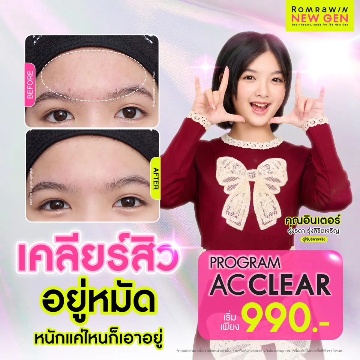 โปรโมชั่นคอร์สรักษาสิว AC Clear ราคาพิเศษ เริ่มต้น 990 บาท รีวิวสิวผดหน้าผาก คุณอินเตอร์ รุ่งรดา รมย์รวินท์คลินิก