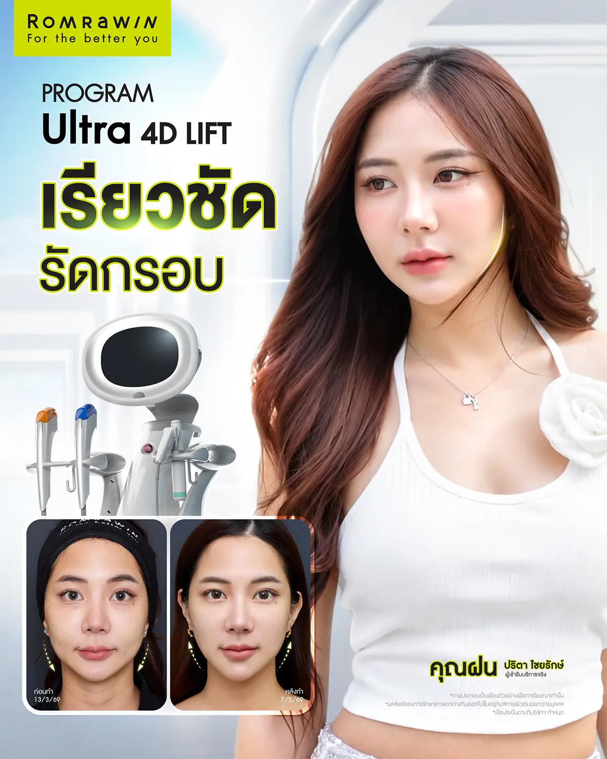 รีวิวผลลัพธ์การยกกระชับปรับรูปหน้าเรียวชัดรัดกรอบหน้าด้วยโปรแกรม Ultraformer รมย์รวินท์คลินิก