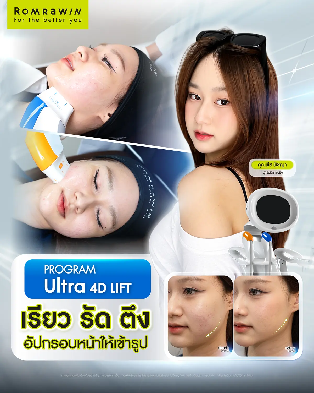 รีวิวเคสคนไข้จริงก่อนและหลังทำหัตถการยกกระชับกรอบหน้าด้วยโปรแกรม Ultraformer รมย์รวินท์คลินิก
