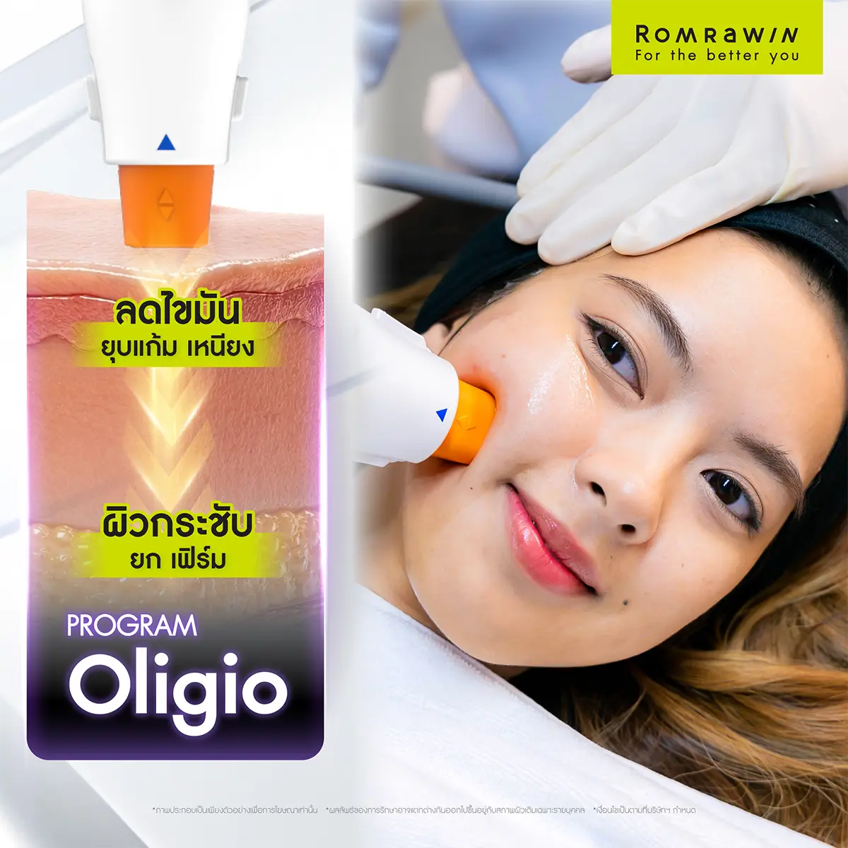 รีวิว Oligio ลดไขมัน ยุบแก้ม เหนียง ผิวกระชับ ยก เฟิร์ม ภาพเคสรีวิวเปรียบเทียบก่อนและหลังทำหัตถการยกกระชับใบหน้าของผู้หญิง