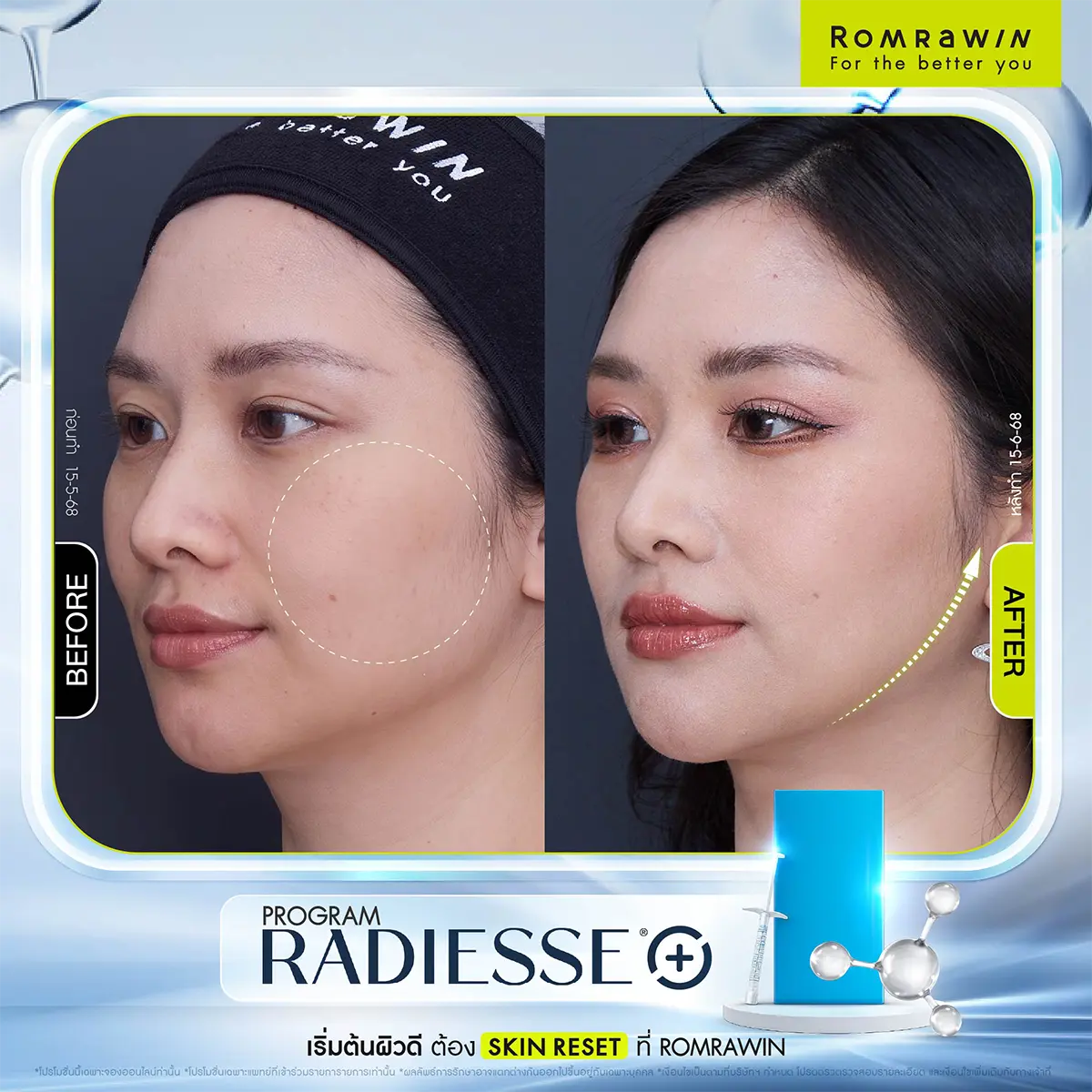 รีวิว Radiesse Romrawin เคสผู้ใช้บริการจริงเปรียบเทียบผิวหน้าก่อนและหลังทำโปรแกรมปรับรูปหน้าแก้ม
