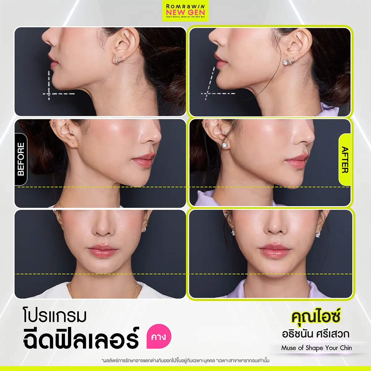 รีวิวฟิลเลอร์คาง เคสคุณไอซ์ภาพเปรียบเทียบก่อนหลังทำโปรแกรมปรับรูปหน้าเพื่อปรับทรงคางให้ดูยาวสมส่วนได้รูป