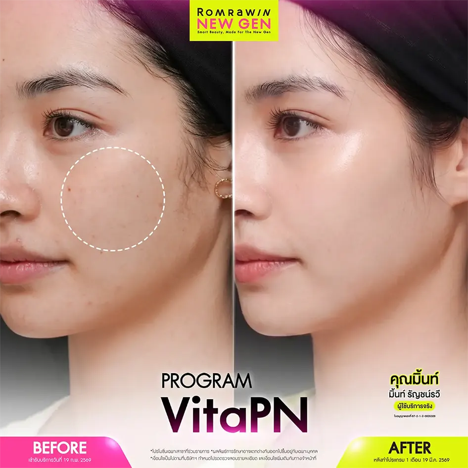 Vita PN (Vitaran) รีวิวเปรียบเทียบผิวหน้าก่อนและหลังทำโปรแกรมฟื้นฟูผิวที่ช่วยลดรอยสิวและปรับจุดด่างดำแก้มใส