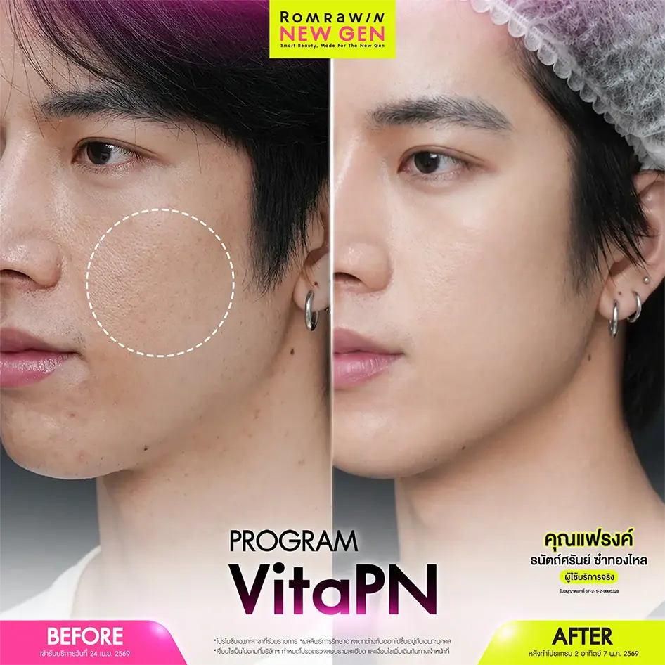 Vita PN (Vitaran) รีวิวเคสคุณแฟรงค์ก่อนหลังทำโปรแกรมกู้ผิวพังช่วยลดปัญหารูขุมขนกว้างปรับแก้มเนียน
