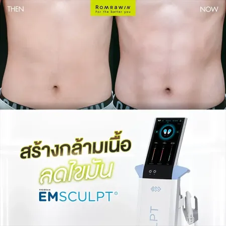 Emsculpt