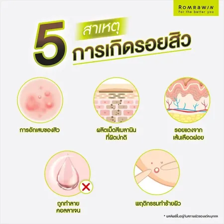 ครีมลดรอยสิว