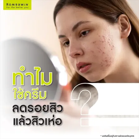 ครีมลดรอยสิว