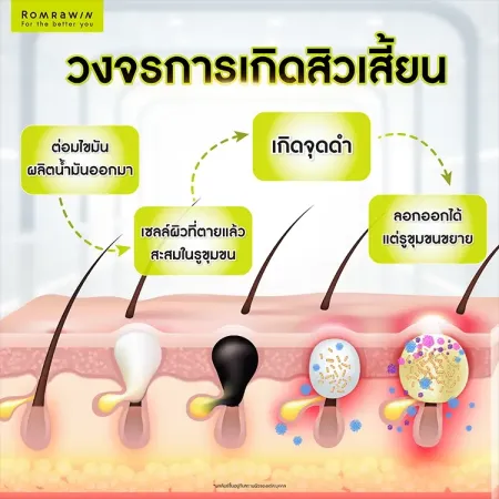 สิวเสี้ยน