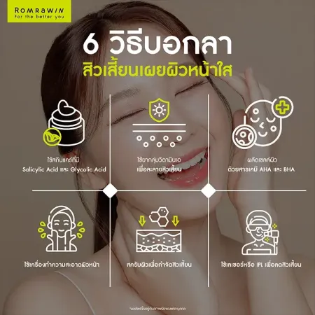 สิวเสี้ยน