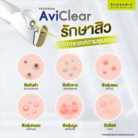 AviClear Laser