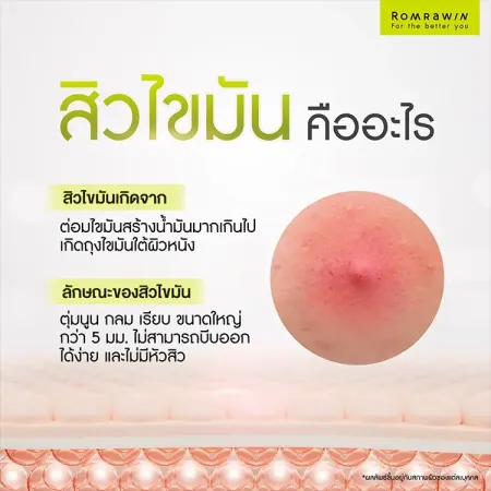 อินโฟกราฟิกอธิบายสาเหตุและลักษณะสิวไขมันพร้อมภาพประกอบขยายตุ่มนูนแดงบนผิวหน้าเพื่อแนะนำวิธีดูแลผิวให้กลับมาเรียบเนียน