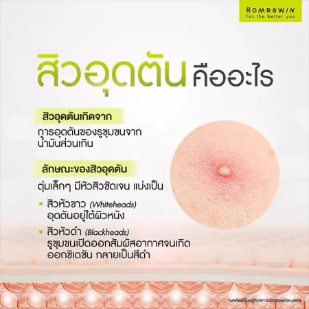 อินโฟกราฟิกความรู้หัวข้อสิวอุดตันคืออะไร พร้อมภาพประกอบซูมตุ่มหนองหัวขาวบนชั้นผิวหนังเพื่อแนะนำวิธีดูแลกู้ผิวโทรม