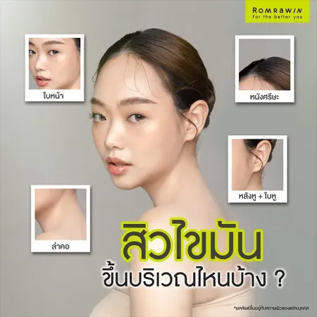 อินโฟกราฟิกแสดงตำแหน่งต่างๆ บนร่างกายที่สามารถเกิดสิวไขมันได้ เช่น ใบหน้า หนังศีรษะ ลำคอ และหลังหู