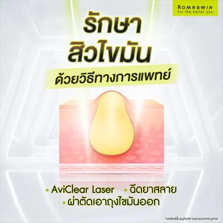 อินโฟกราฟิกแนะนำทางเลือกการดูแลสิวไขมันด้วยวิธีทางการแพทย์โดยแสดงภาพจำลองโครงสร้างถุงไขมันใต้ชั้นผิวหนังอย่างชัดเจน