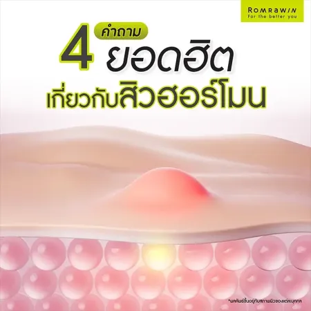 สิวฮอร์โมน