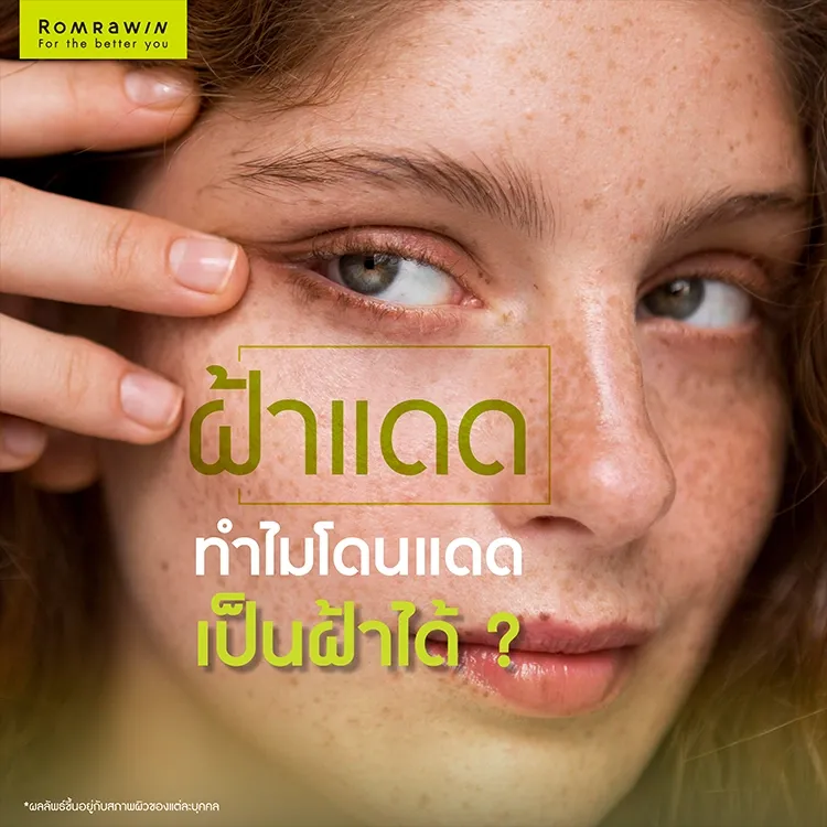 ฝ้าแดด คืออะไร ทำไมแค่โดนแดดก็เป็นฝ้าได้ พร้อมวิธีรักษาให้จางลง