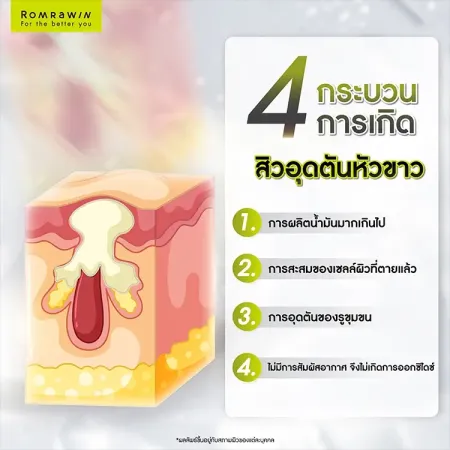 สิวอุดตันหัวขาว
