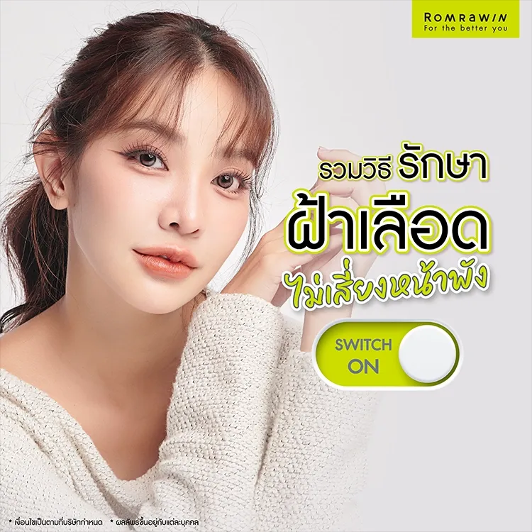 รักษาฝ้าเลือดแบบปลอดภัย เหมาะกับทุกสภาพผิว ไม่เสี่ยงหน้าพัง