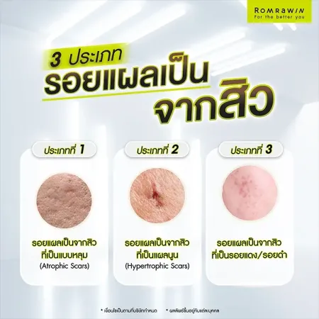 แผลเป็นจากสิว