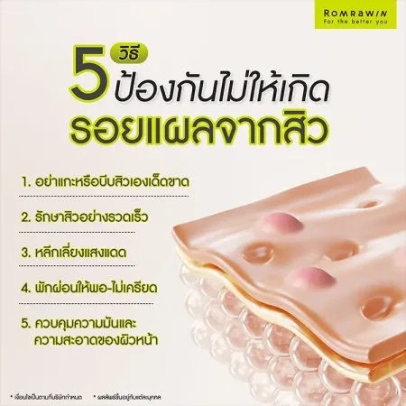 แผลเป็นจากสิว