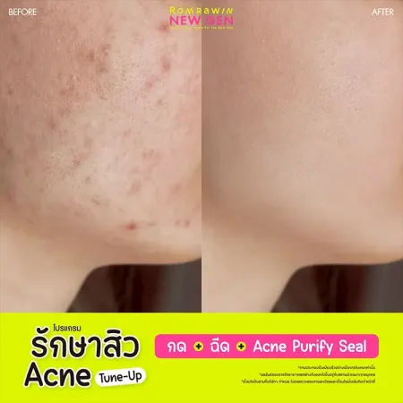 รักษาสิว Acne Tune-Up 790