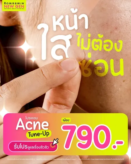 Acne Tune-Up 790