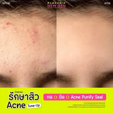 รักษาสิว Acne Tune-Up 790