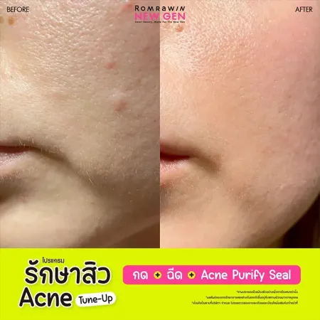รักษาสิว Acne Tune-Up 790