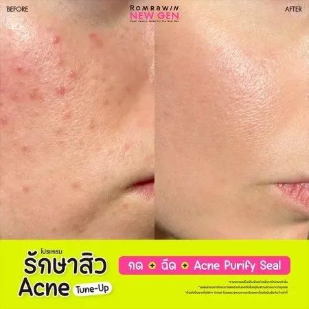 รักษาสิว Acne Tune-Up 790