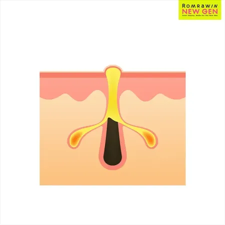 Acne Tune-Up 790