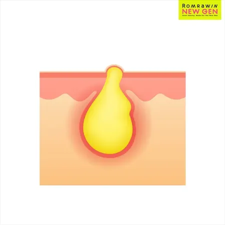 Acne Tune-Up 790