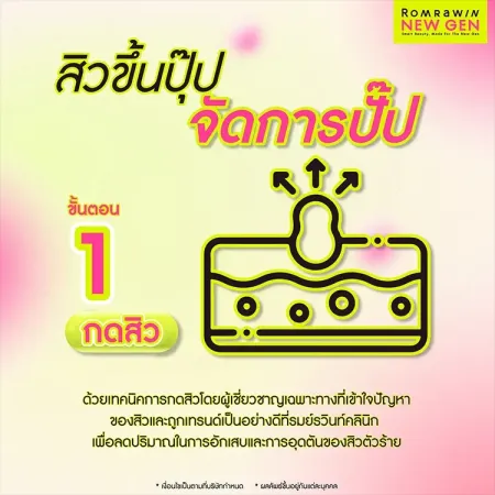 รักษาสิว Acne Tune-Up 790