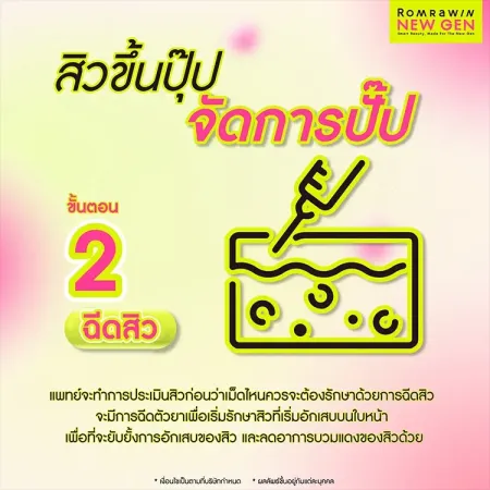 รักษาสิว Acne Tune-Up 790