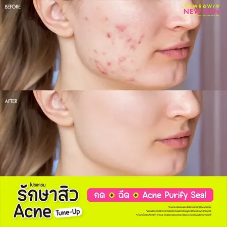 รักษาสิว Acne Tune-Up 790
