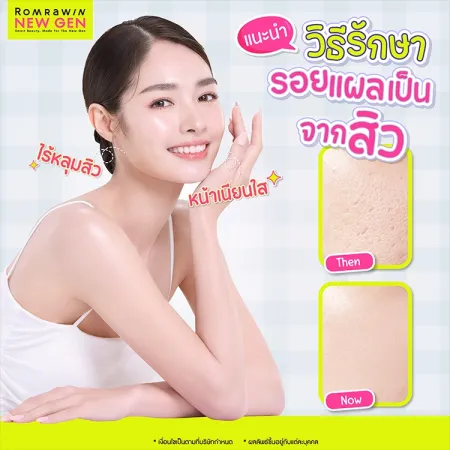 10 วิธีรักษารอยแผลเป็นจากสิว ลดรอยดำ คืนความเรียบเนียนให้ผิวหน้า