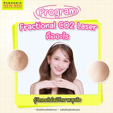 Fractional CO2 Laser คืออะไร รักษาหลุมสิวกี่ครั้งเห็นผล