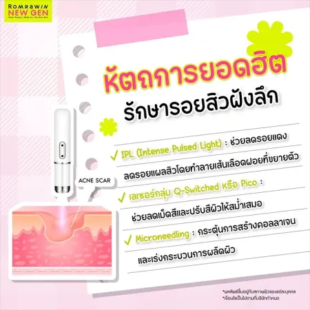 รอยแผลสิว