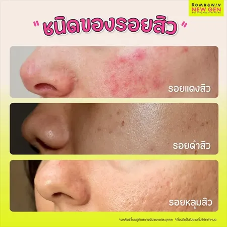 เลเซอร์รอยสิว
