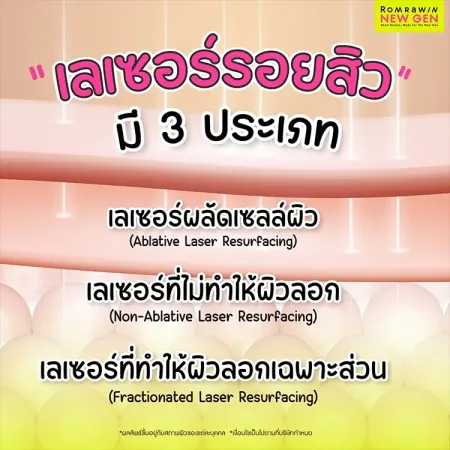 เลเซอร์รอยสิว