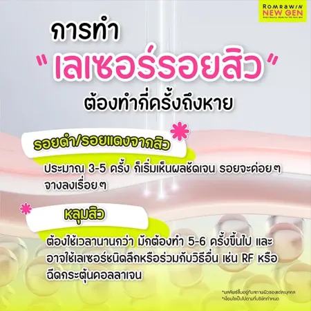เลเซอร์รอยสิว