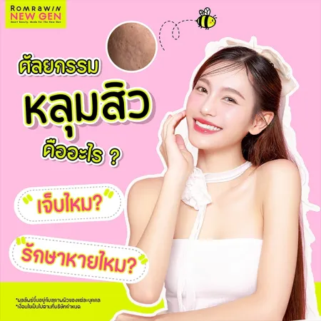 ศัลยกรรมหลุมสิว คืออะไร รักษาหลุมสิวได้จริงไหม ราคาเท่าไหร่