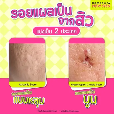 ลดรอยแผลเป็นสิว