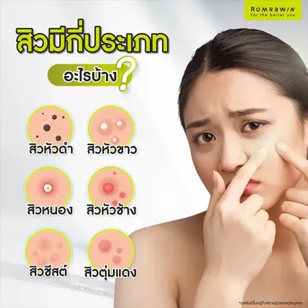 สิว