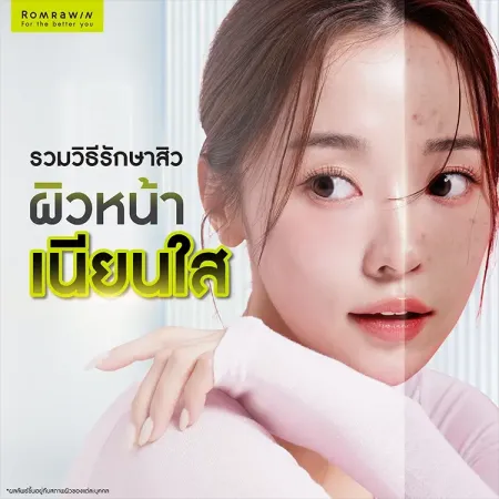 สิว
