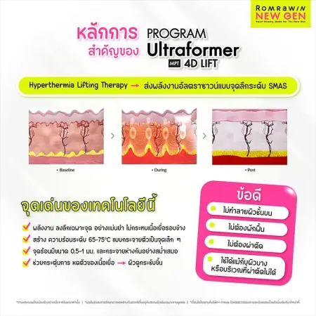 หลักการสำคัญของ PROGRAM Ultraformer MPT 4D LIFT ส่งพลังงานอัลตราซาวนด์แบบจุดลึกระดับ SMAS