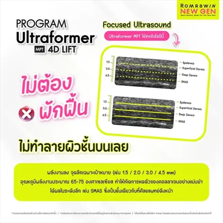 PROGRAM Ultraformer MPT 4D LIFT ไม่ต้องพักฟื้น ไม่ทำลายผิวชั้นบนเลย รีวิวยกกระชับหน้าลึกถึงชั้น SMAS