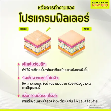 ฟิลเลอร์