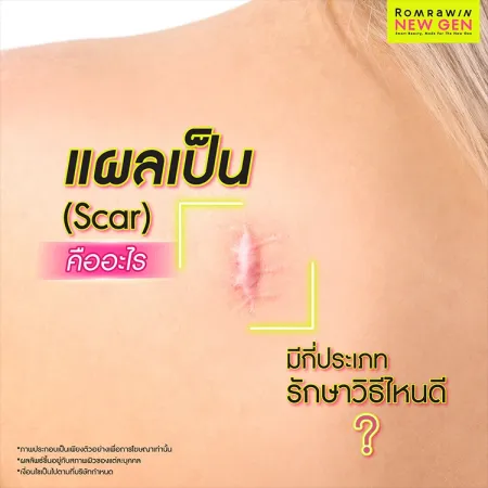 แผลเป็น (Scar) คืออะไร มีกี่ประเภท รักษาวิธีไหนดีให้หาย