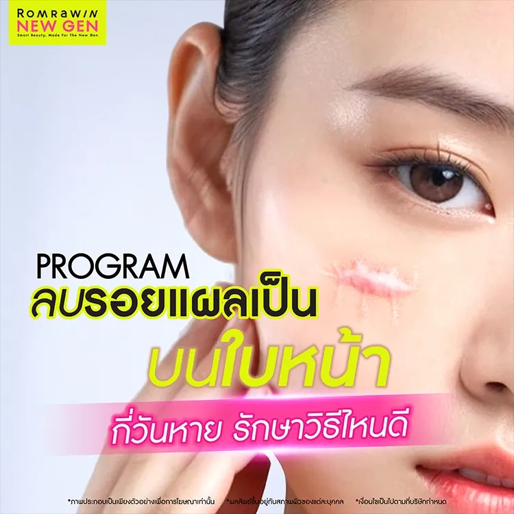 ลบรอยแผลเป็นบนใบหน้า คืออะไร สาเหตุเกิดจาก กี่วันหาย รักษาวิธีไหนดี